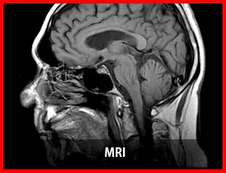 mri 2