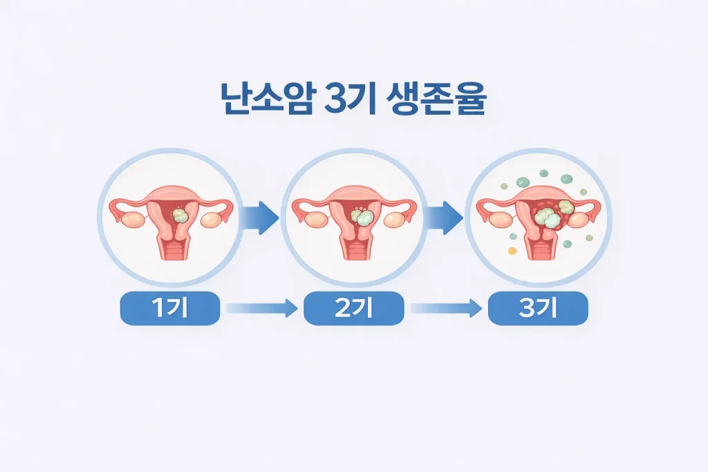 난소암 생존율 관련 이미지