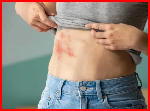 대상포진 증상1