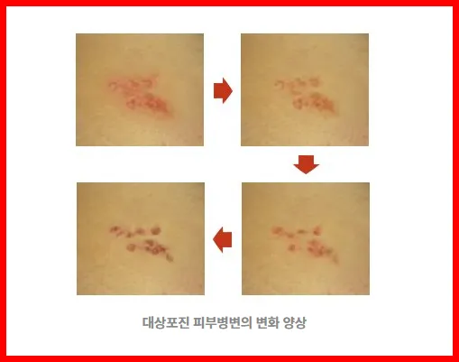 대상포진 피부병변