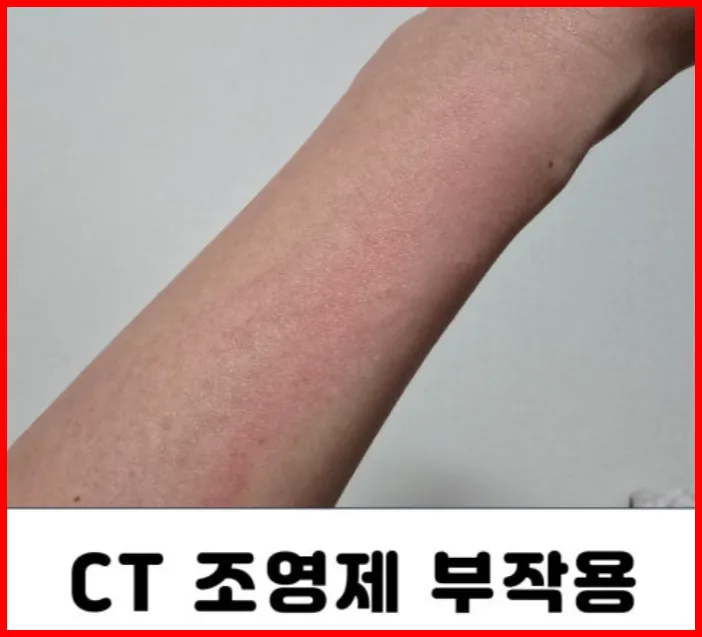 조영제 부작용2